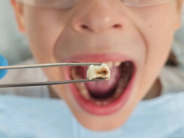 Best Emergency Wisdom Teeth Removal in Newstle, CA
